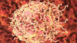Colorectal cancer accordion image