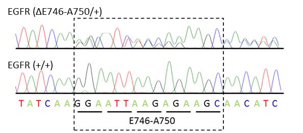 Chromatograph showing heterozygosity for the E746-A750 deletion within EGFR exon 19 (transcript ID: ENST00000275493) (SNP accession number: rs121913421)